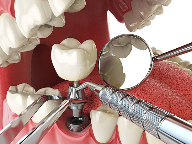 Best Emergency Root Canal Treatment in Fruitland, ID